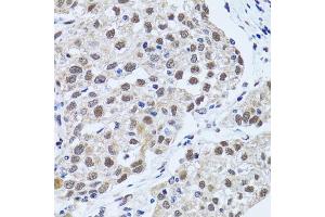 Immunohistochemistry of paraffin-embedded human lung cancer using TP53BP1 antibody (ABIN5973380) at dilution of 1/100 (40x lens). (TP53BP1 抗体)