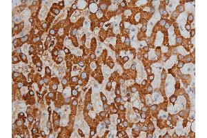 ABIN6256332 and ABIN6267233 at 1/200 staining human liver cancer tissue sections by IHC-P. (HDAC3 抗体  (pSer424))