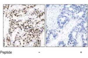 Immunohistochemical analysis of paraffin-embedded human breast carcinoma tissue using MYC polyclonal antibody  .