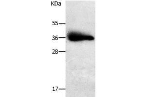 Western Blot analysis of Human liver cancer tissue using PLPP1 Polyclonal Antibody at dilution of 1:650 (PLPP1 抗体)
