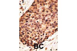 Formalin-fixed and paraffin-embedded human cancer tissue reacted with MMP16 polyclonal antibody  , which was peroxidase-conjugated to the secondary antibody, followed by AEC staining. (MMP16 抗体  (N-Term))