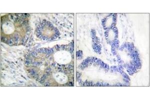 Immunohistochemistry analysis of paraffin-embedded human colon carcinoma tissue, using 4E-BP1 (Ab-64) Antibody. (eIF4EBP1 抗体  (AA 30-79))