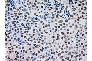 Immunohistochemical staining of paraffin-embedded Carcinoma of pancreas tissue using anti-MRI1mouse monoclonal antibody. (MRI1 抗体)