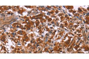 Immunohistochemistry of paraffin-embedded Human thyroid cancer using ING2 Polyclonal Antibody at dilution of 1:40 (ING2 抗体)