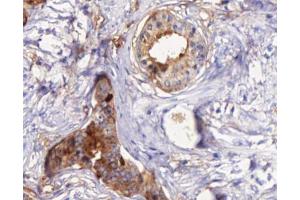 ABIN6266873 at 1/100 staining human Prostate cancer tissue sections by IHC-P. (STEAP4 抗体  (C-Term))