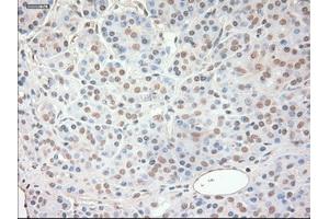 Immunohistochemical staining of paraffin-embedded Adenocarcinoma of ovary tissue using anti-SOX17 mouse monoclonal antibody. (SOX17 抗体  (AA 177-414))