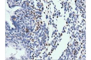 Immunohistochemical staining of paraffin-embedded Adenocarcinoma of Human endometrium tissue using anti-ARHGAP25 mouse monoclonal antibody. (ARHGAP25 抗体)