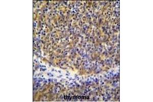 PSMB11 Antibody (C-term) (ABIN655286 and ABIN2844876) immunohistochemistry analysis in formalin fixed and paraffin embedded human thymoma followed by peroxidase conjugation of the secondary antibody and DAB staining. (PSMB11 抗体  (C-Term))