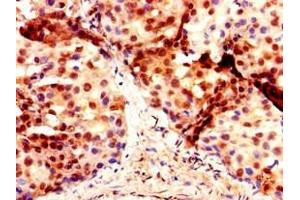 Immunohistochemistry of paraffin-embedded human breast cancer using ABIN7150637 at dilution of 1:100 (DMRT1 抗体  (AA 195-363))