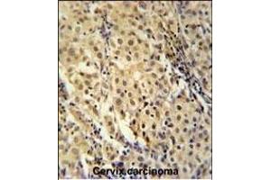 FOXC2 Antibody (Center ) (ABIN651936 and ABIN2840463) immunohistochemistry analysis in formalin fixed and paraffin embedded human cervix carcinoma followed by peroxidase conjugation of the secondary antibody and DAB staining. (FOXC2 抗体  (AA 159-186))