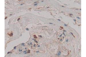 DAB staining on IHC-P; Samples: Human Breast cancer Tissue (Cathepsin D 抗体  (AA 169-408))