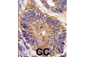 Formalin-fixed and paraffin-embedded human colon carcinoma tissue reacted with LDLRAP1 polyclonal antibody  , which was peroxidase-conjugated to the secondary antibody, followed by DAB staining. (LDLRAP1 抗体  (N-Term))