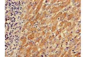 Immunohistochemistry of paraffin-embedded human liver cancer using ABIN7173558 at dilution of 1:100 (TPM3 抗体  (AA 18-224))