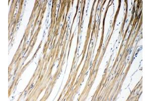 IHC testing of FFPE human intestinal cancer tissue with GJC1 antibody at 1ug/ml. (GJC1 抗体  (AA 91-131))