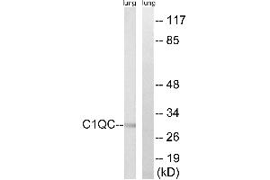 Immunohistochemistry analysis of paraffin-embedded human lung carcinoma tissue, using C1QC antibody. (C1QC 抗体)