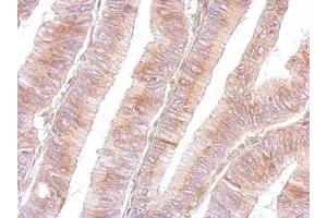 IHC-P Image B3GNT3 antibody detects B3GNT3 protein at cytosol on human colon by immunohistochemical analysis. (B3GNT3 抗体)