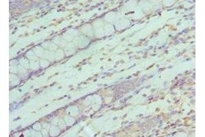 Immunohistochemistry of paraffin-embedded human colon cancer using ABIN7170622 at dilution of 1:100 (SF3B2 抗体  (AA 616-895))