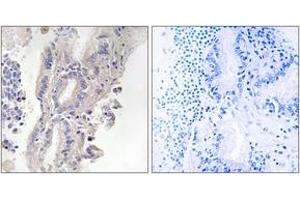 Immunohistochemistry analysis of paraffin-embedded human lung carcinoma, using PLCXD1 Antibody. (PLCXD1 抗体  (AA 187-236))