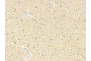 ABIN6259890 and ABIN6279111 at 1/100 staining human glioblastoma by IHC-P.