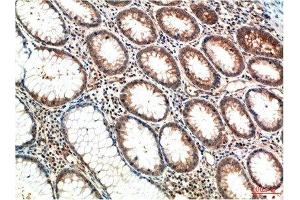 Immunohistochemical analysis of paraffin-embedded Human Colon Carcinoma Tissue using ATM Mouse mAb diluted at 1:200. (ATM 抗体)