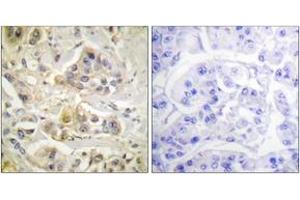 Immunohistochemistry analysis of paraffin-embedded human breast carcinoma tissue, using AhR (Ab-36) Antibody. (Aryl Hydrocarbon Receptor 抗体  (AA 2-51))
