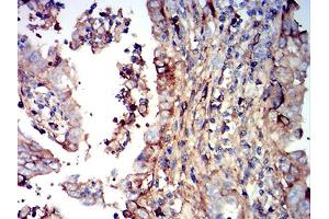Immunohistochemical analysis of paraffin-embedded endometrial cancer tissues using IGHM mouse mAb with DAB staining. (IGHM 抗体  (AA 310-452))