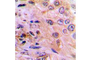 Immunohistochemical analysis of DUSP6 staining in human lung cancer formalin fixed paraffin embedded tissue section. (DUSP6 抗体  (Center))