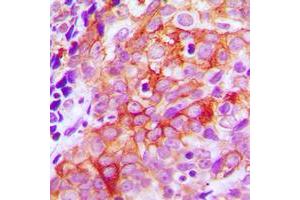 Immunohistochemical analysis of Beta-2 Adrenergic Receptor staining in human prostate cancer formalin fixed paraffin embedded tissue section. (beta 2 Adrenergic Receptor 抗体  (C-Term))