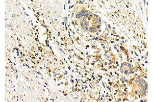 ABIN6263511 and ABIN6276331 at 1/100 staining Human esophageal cancer by IHC-P. (NAMPT 抗体  (C-Term))