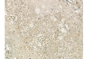 ABIN6259541 and ABIN6273711 at 1/100 staining human prostate carcinoma by IHC-P.
