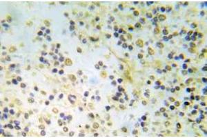 Immunohistochemistry (IHC) analyzes of p-ER-a (pSer118) pAb in paraffin-embedded human breast carcinoma tissue. (Estrogen Receptor alpha 抗体  (pSer118))