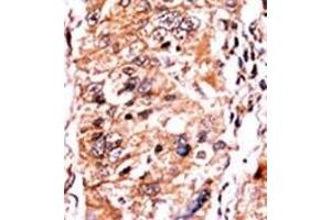 Immunohistochemistry (Paraffin-embedded Sections) (IHC (p)) image for anti-Cyclin-Dependent Kinase Inhibitor 2A (Melanoma, P16, Inhibits CDK4) (CDKN2A) (pSer140) antibody (ABIN6241061)