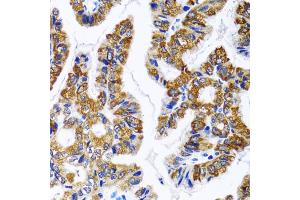 Immunohistochemistry of paraffin-embedded human gastric cancer using FASN antibody. (Fatty Acid Synthase 抗体)