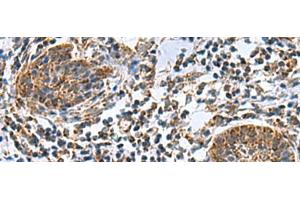 Immunohistochemistry of paraffin-embedded Human esophagus cancer tissue using MRPL40 Polyclonal Antibody at dilution of 1:80(x200) (MRPL40 抗体)
