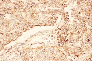 Anti-AKT2 Picoband antibody,  IHC(P): Human Lung Cancer Tissue (AKT2 抗体  (C-Term))