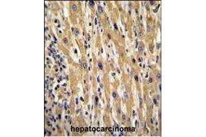 GAL Antibody (Center) (ABIN655055 and ABIN2844684) immunohistochemistry analysis in formalin fixed and paraffin embedded human hepatocarcinoma followed by peroxidase conjugation of the secondary antibody and DAB staining. (GAL 抗体  (AA 48-79))
