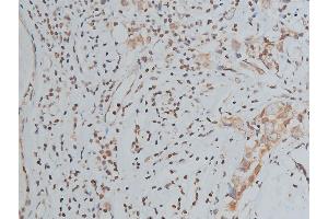 ABIN6267039 at 1/200 staining human breast cancer tissue sections by IHC-P. (Histone 3 抗体)