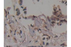Detection of CKMT1A in Human Breast cancer Tissue using Polyclonal Antibody to Creatine Kinase, Mitochondrial 1A (CKMT1A)