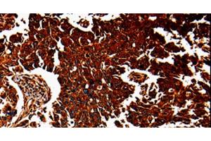 Immunohistochemistry of paraffin-embedded Human lung cancer tissue using ANXA7 Polyclonal Antibody at dilution 1:40 (Annexin VII 抗体)