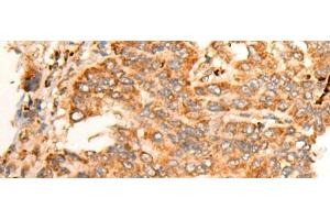 Immunohistochemistry of paraffin-embedded Human liver cancer tissue using BPGM Polyclonal Antibody at dilution of 1:70(x200) (BPGM 抗体)