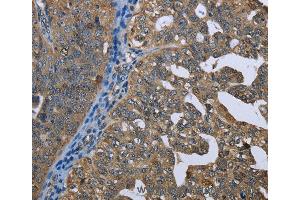 Immunohistochemistry of Human gastric cancer using GPAM Polyclonal Antibody at dilution of 1:60 (GPAM 抗体)