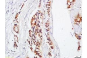 Formalin-fixed and paraffin embedded human colon carcinoma labeled with Anti-IL-17C Polyclonal Antibody, Unconjugated  at 1:200 followed by conjugation to the secondary antibody and DAB staining. (IL17C 抗体  (AA 101-197))