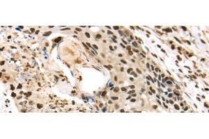 Immunohistochemistry of paraffin-embedded Human esophagus cancer using TALDO1 Polyclonal Antibody at dilution of 1/30 (TALDO1 抗体)