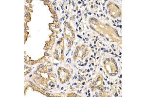 Immunohistochemistry of paraffin-embedded human kidney cancer using ARRB2 antibody (ABIN6290073) at dilution of 1:200 (40x lens). (Arrestin 3 抗体)