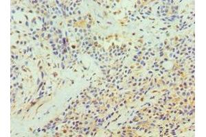 Immunohistochemistry of paraffin-embedded human breast cancer using ABIN7172210 at dilution of 1:100 (TFPI2 抗体  (AA 23-235))