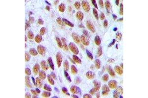Immunohistochemical analysis of p300 staining in human breast cancer formalin fixed paraffin embedded tissue section. (p300 抗体  (N-Term))