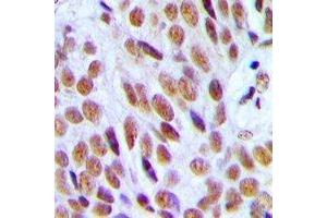 Immunohistochemical analysis of p300 staining in human breast cancer formalin fixed paraffin embedded tissue section.