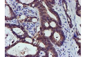 Immunohistochemical staining of paraffin-embedded Adenocarcinoma of Human colon tissue using anti-SMS mouse monoclonal antibody. (SMS 抗体)