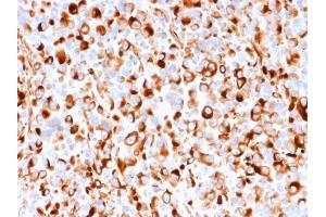 Formalin-fixed, paraffin-embedded human Melanoma stained with NGFR Mouse Recombinant Monoclonal Antibody (rNGFR/1965). (Recombinant NGFR 抗体  (AA 281-421))