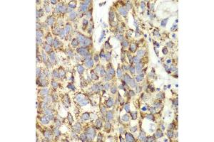Immunohistochemistry of paraffin-embedded human lung cancer using UGDH antibody (ABIN6293152) at dilution of 1:100 (40x lens). (UGDH 抗体)